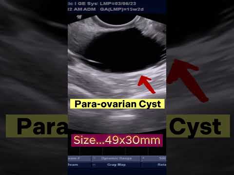 Ultrasound Para Ovarian Cyst