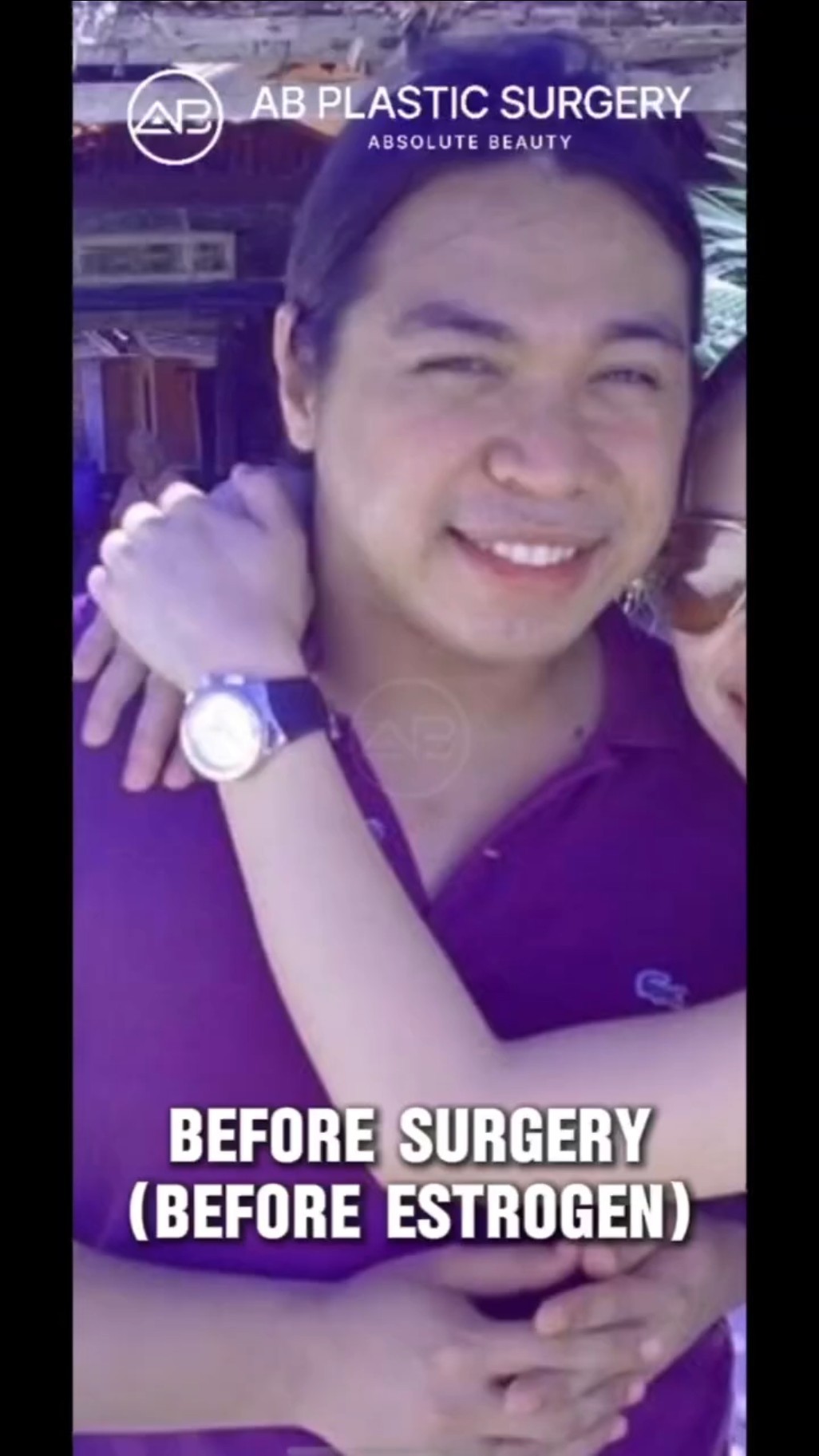MTF Transformation: Unbelievable Facial Feminization Surgery Results!