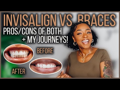 INVISALIGN VS. BRACES | PROS & CONS OF EACH ORTHODONTIST TREATMENT + MY JOURNEYS!