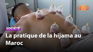 La «hijama», une médecine ancestrale qui compte de plus en d’adeptes