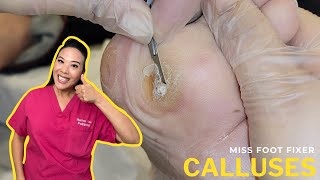 How To Remove Calluses From Feet Quickly & Safely: Effective Home Treatment | Miss Foot Fixer