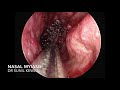 #111 Nasal Myiasia | Maggots in Nose | Endoscopic maggots Removal - Dr Sunil Kewat #111 Nasal Myiasia | Maggots in Nose | Endoscopic maggots Removal