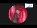 Endoscopic Endonasal Decompression of the Lamina Papyracea