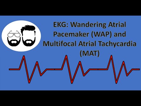 image-What is MAT in ECG?