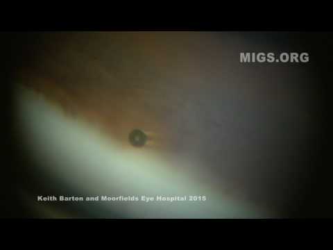 Xen on gonioscopy - postoperative appearance 2015