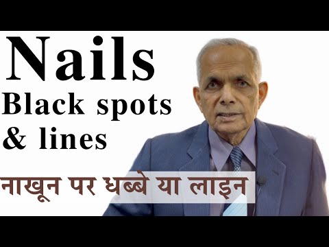 Nails black lines and black spots: Black lines or spots on nails #blacknails #nails