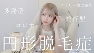 【悲報】円形脱毛症になりました。