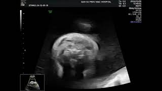 Asvide: Two-dimensional dynamic scanning in the transverse section of the neck revealed an...