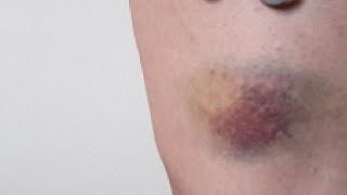 how to get rid of bruises on arms fast