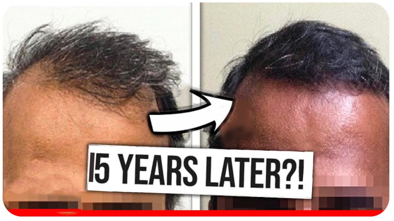 Why hair transplants last forever