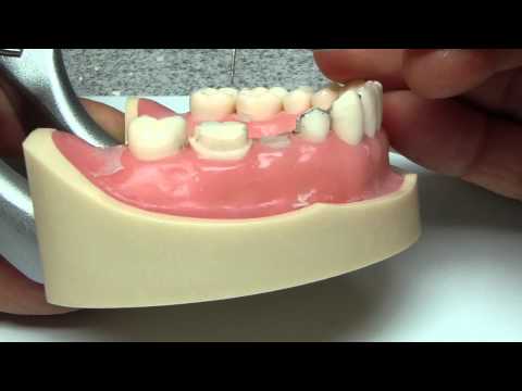 3/4 crown 3 unit FDP prep