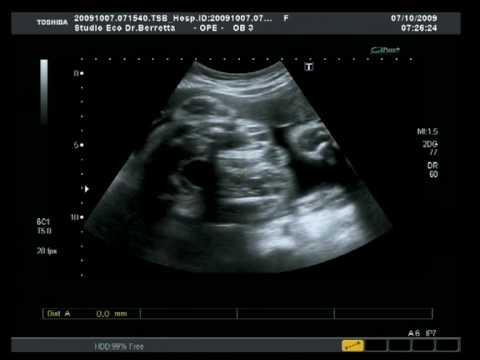 Giunti in bambini dopo un anno Lorlett ginocchiera RKN 103
