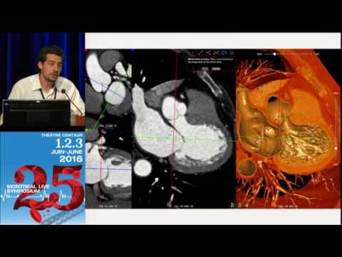13 - State of the Art Imaging for Mitral Valve Therapy - Nicolo Piazza