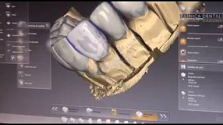 Promo escáner intraoral Clínica Dental Crooke & Laguna