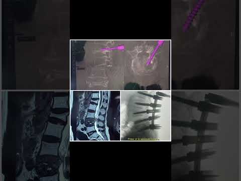 Navigated minimal invasive spine surgery osteoporotic vertebral compression fracture #roboticsurgery| Dr. Ajay Kothari