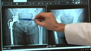 Orthopédie: Révision d'une prothèse de hanche