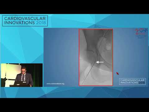 CVI2018 Session: Back to the PCI basics (Mt. Sopris Rm, July 28, 10:30 am)