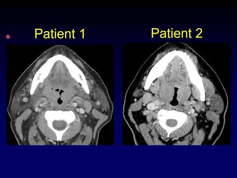 Head to Head: Waldeyer's Ring