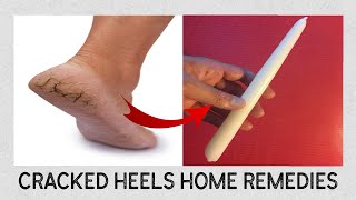 how can i permanently fix my cracked heels|| 100% Works.