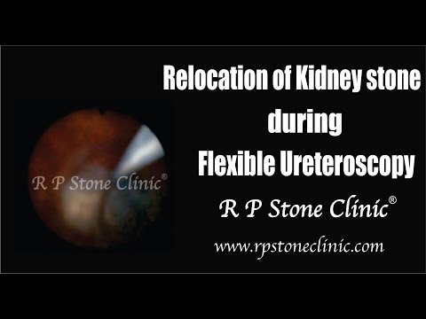 Relocation of Kidney Stone During Flexible Ureteroscopy / RIRS Surgery