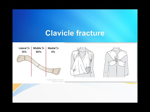 Clavicle fracture