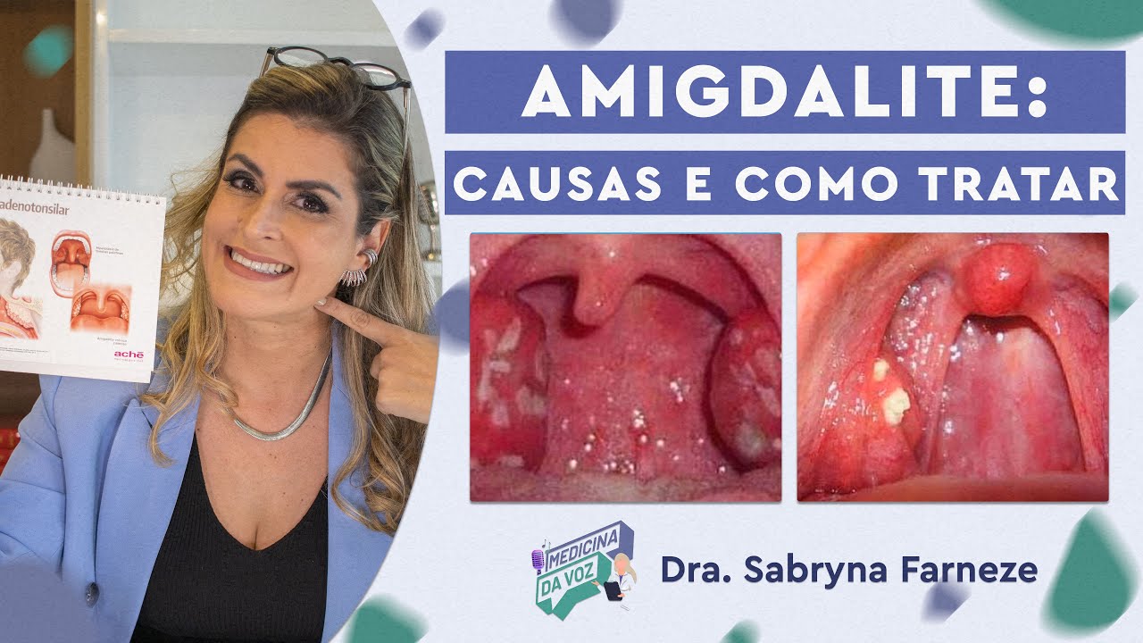 Amigdalite: Causas e como tratar.
