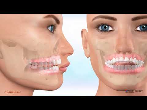 Myofunctional Therapy for Open Bite Corrections Class II Carriere Motion 3D Finished with Aligners