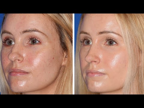 Septoplasty & Rhinoplasty Testimony