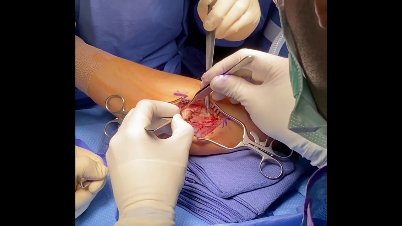 Dr. Garcia demonstrates his technique for acute elbow LCL repair