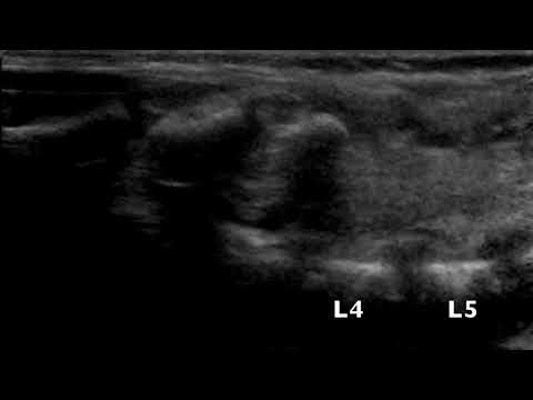 Spinal US - conus at L5