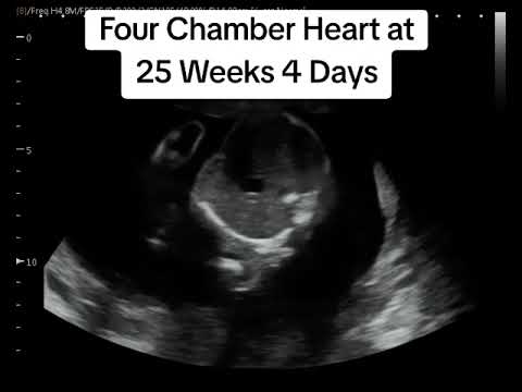Baby Heartbeat on 2D Ultrasound at 25 Weeks 4 Days Pregnant #heybabymobile #heartbeat #rochesterny