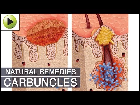 Home Remedies for Carbuncles