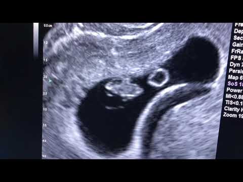 Sonogram: 8 weeks pregnant!