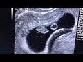 Sonogram: 8 weeks pregnant!