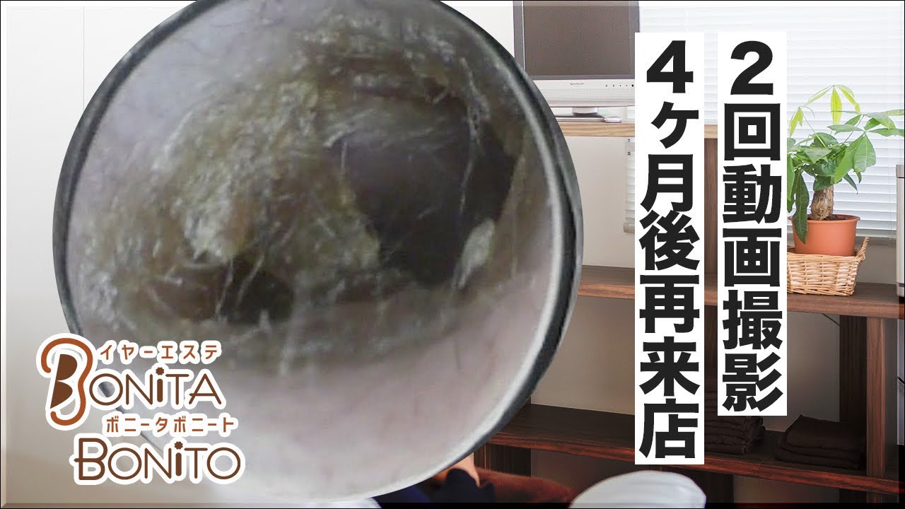 #耳掃除　鼓膜にくっついて残した耳垢！2回撮影。4ヶ月後に再来店👂