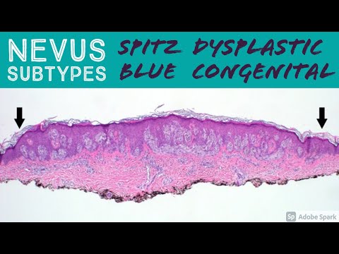 Spitz Nevus, Dysplastic Nevus, Blue Nevus, Congenital Nevus & more - Dermatopathology Basics