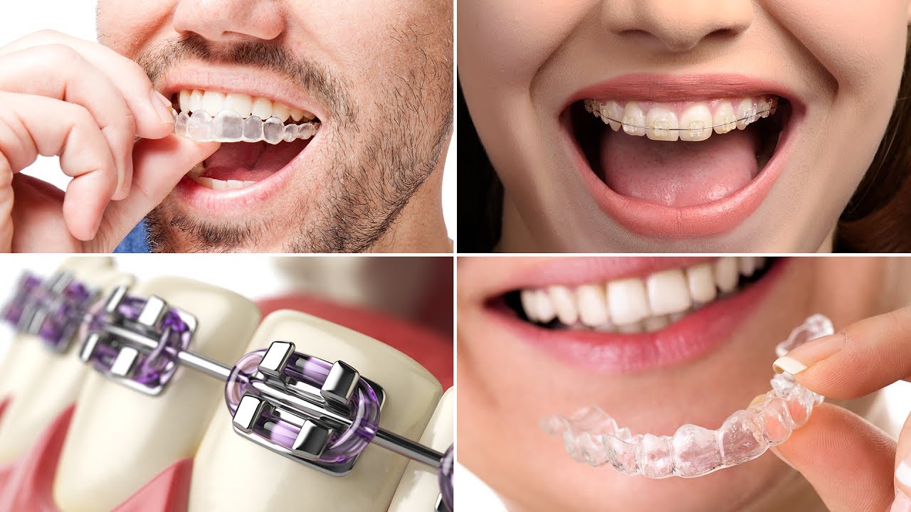 About braces and how they have changed