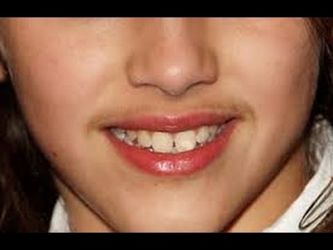 Metode pelangsing frame 25 Kehilangan manfaat dari hati