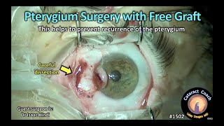 CataractCoach 1502: pterygium surgery with free graft