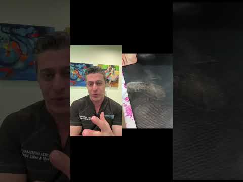 THIS Is Why You Don't Pop Cysts!