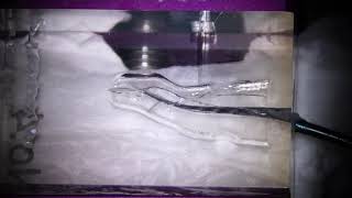 Management of double curvature (S-shaped canal) with a ledge on the second apical curve using T-mode