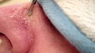 How To Remove Blackheads Using Extractor Tool Surgical Kit