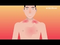 How to Get Rid of Heat Rash