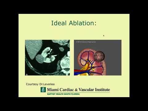 SIR-RFS Webinar (9/17/2018): Percutaneous Renal Ablations