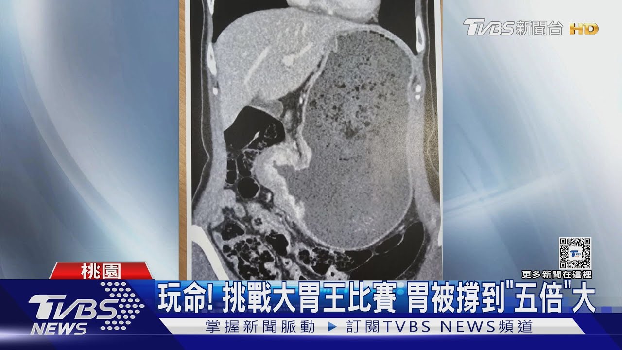 玩命!挑戰大胃王比賽 胃被撐到「五倍」大