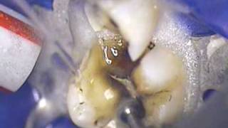 DR. GERARD CUOMO - Restoring severely broken down dental fillings Cosmetic Boca Raton, Florida