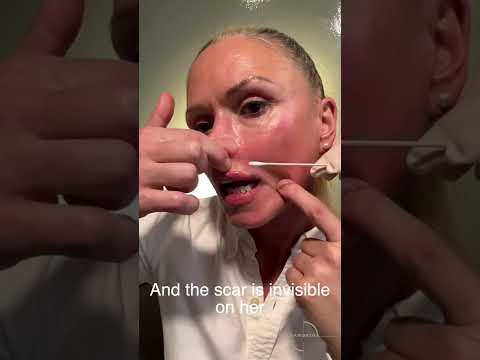 Post Lip Lift- Lip Exercises by Dr Haworth