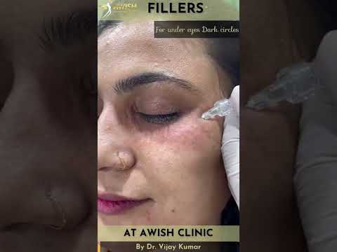 Woman With Dark Circles Get Under-Eye Filler Injections For The First Time | AwishClinic.com #shorts