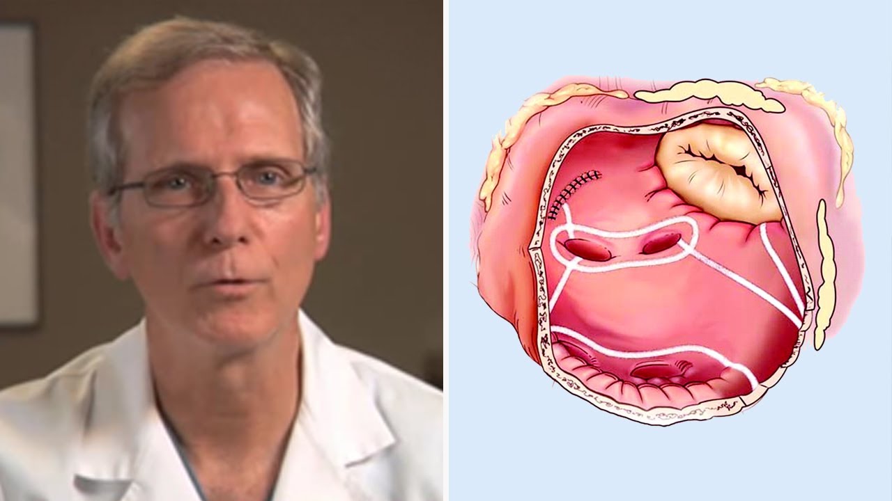 Concomitant AFib Treatment During Coronary Bypass & Aortic Valve Surgery with Dr. Glenn Barnhart