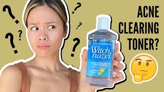 Witch Hazel for Acne : Good Or Bad Get The Facts